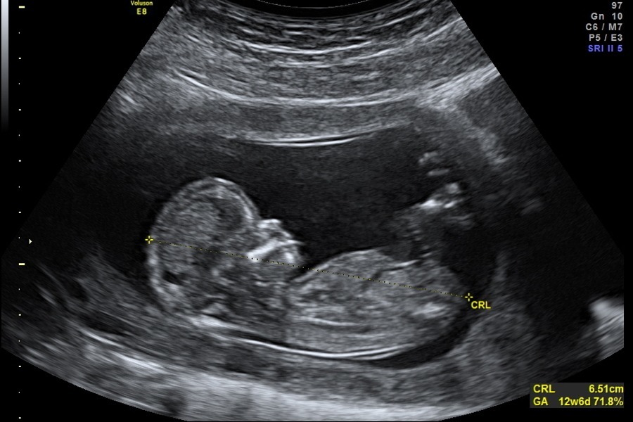 fetus-ultrasound